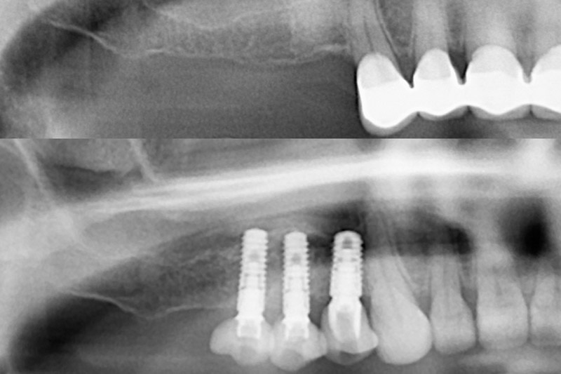 bone